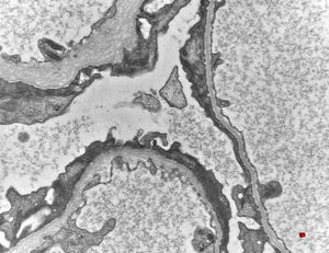 F,14y. | Alport syndrome - split and laminated, thick/thin basement membranes F,14y. | Alport syndrome - split and laminated, thick/thin basement membranes